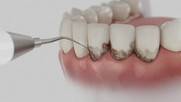 Trusted Wisdom Tooth Removal service in Colleyville, TX - Dentist Open Now